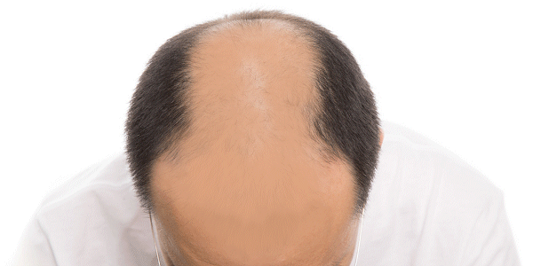 薄毛の原因はジヒドロテストステロン（DHT）