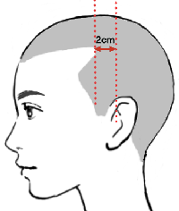耳の穴～頭頂とM字部分が2cm以内なら薄毛